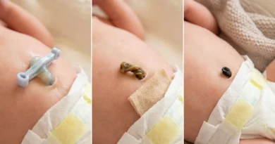 Trzy etapy gojenia kikuta pępowiny noworodka: świeży z klamrą, podsychający żółtobrązowy oraz suchy i czarny.
